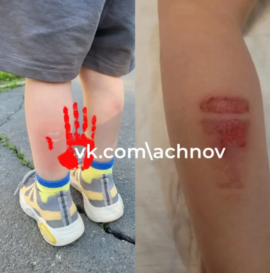 Ребёнок получил ожог ноги во время поездки в автобусе №2. Следователи запросили у перевозчика документы и проверяют техническое состояние транспорта.